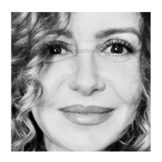 Dopo Blefaroplastica superiore 2.0