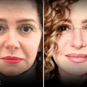 Prima dopo Blefaroplastica superiore 2.0