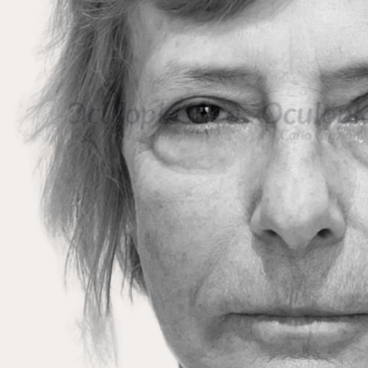 Prima dopo EyeDefine Lyft Blefaroplastica superiore 2.0