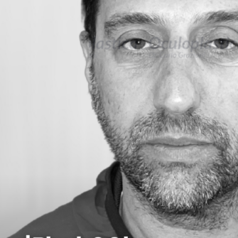 Blefaroplastica superiore Ptosi palpebrale Blefaroplastica superiore Ptosi palpebrale