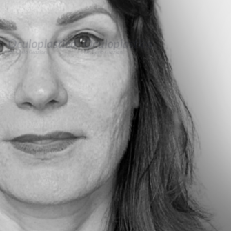 Blefaroplastica superiore Ptosi palpebrale Blefaroplastica superiore Ptosi palpebrale