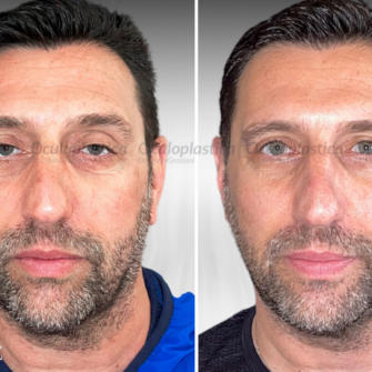 Prima Dopo Bleph 2.0 Blefaroplastica superiore Ptosi palpebrale Prima Dopo Bleph 2.0 Blefaroplastica superiore Ptosi palpebrale