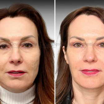 Prima Dopo Bleph 2.0 Blefaroplastica superiore Ptosi palpebrale Prima Dopo Bleph 2.0 Blefaroplastica superiore Ptosi palpebrale