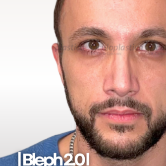 Bleph 2.0 Prima dopo Bleph 2.0 Prima dopo