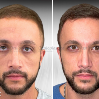 Prima Dopo Bleph 2.0 Blefaroplastica superiore Ptosi palpebrale Prima Dopo Bleph 2.0 Blefaroplastica superiore Ptosi palpebrale