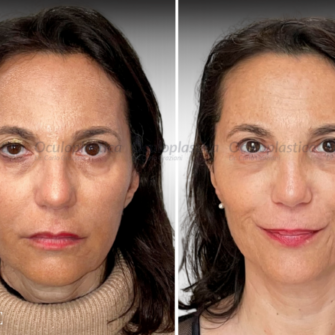 Prima Dopo Bleph 2.0 Blefaroplastica superiore Ptosi palpebrale Prima Dopo Bleph 2.0 Blefaroplastica superiore Ptosi palpebrale