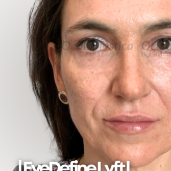 Prima dopo EyeDefineLyft Prima dopo EyeDefineLyft