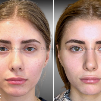 Prima Dopo EyeGlow Contour palpebre superiori asimmetria occhi incavati