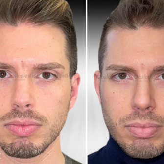 Prima Dopo EyeGlow Contour Hunter Eyes filler palpebra superiore asimmetria