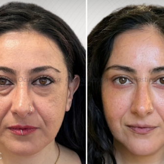 PRIMA DOPO LIFTING MALARE, CANTOPLASTICA E LIPOFILLING