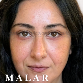 PRIMA DOPO LIFTING MALARE, CANTOPLASTICA E LIPOFILLING